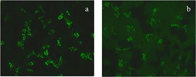 Psychotic Symptoms as the Initial Presentation of a Long-Lasting Misdiagnosed Anti-GAD65 Autoimmune Encephalitis: An Emblematic Case and Literature Review